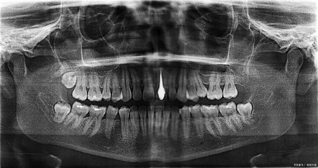 牙损伤,牙脱位,牙根折裂,牙齿发育异常,根尖周炎,致密性骨严,牙骨质