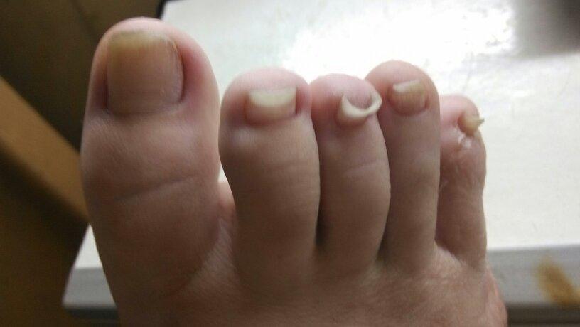 脚趾甲翘起来 怎么回事 怎么办呢