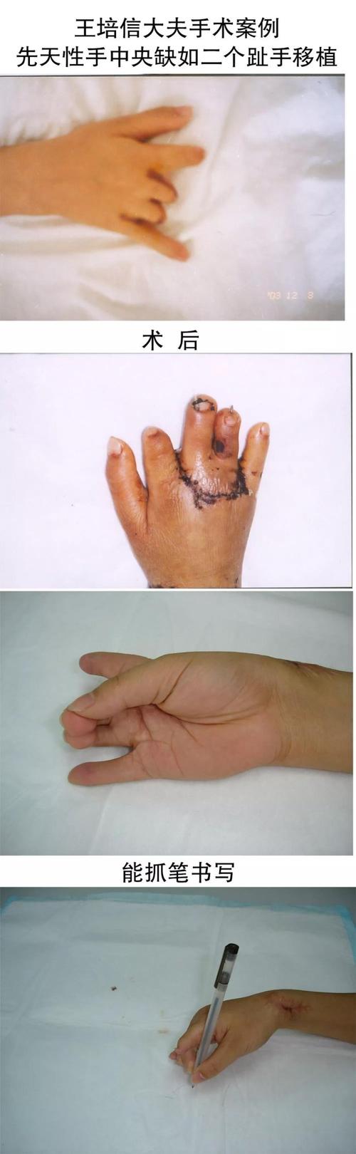 先天性手中央缺如,行第2,第3脚趾联合移植重建缺如示,中指,术后功能
