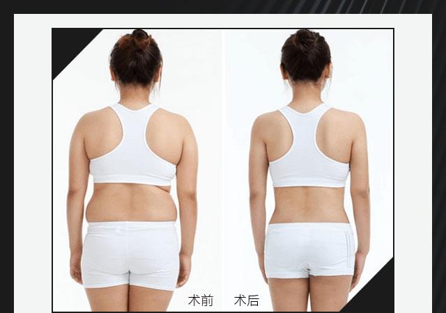 背部吸脂