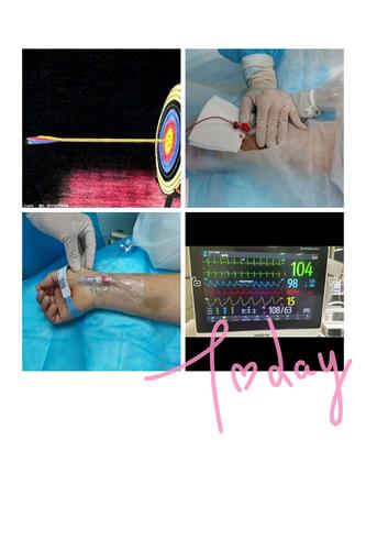 超声让桡动脉置管插上翅膀