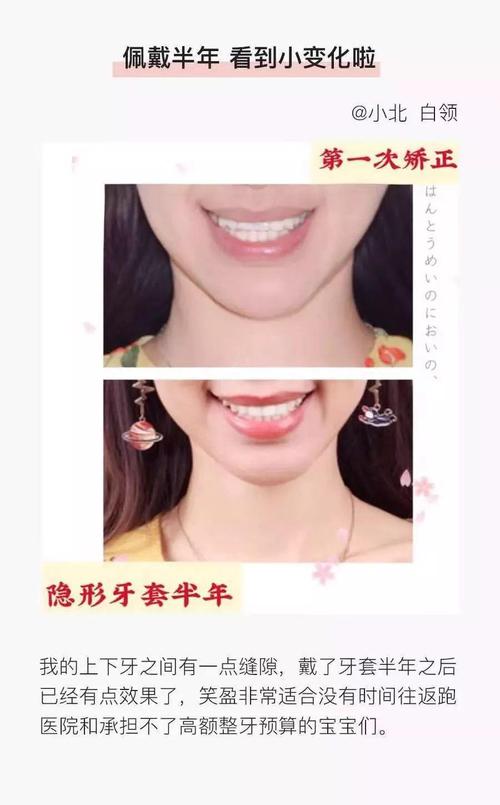 深扒牙齿矫正内幕,只要1万多的隐形牙套是什么神仙牙套啊?