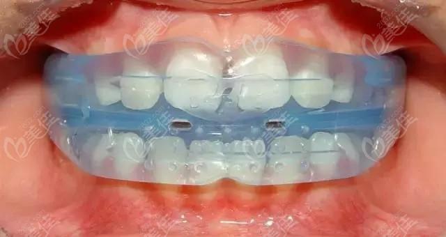 国外禁用儿童mrc矫正器难道是因孩子佩戴myobrace嘴巴