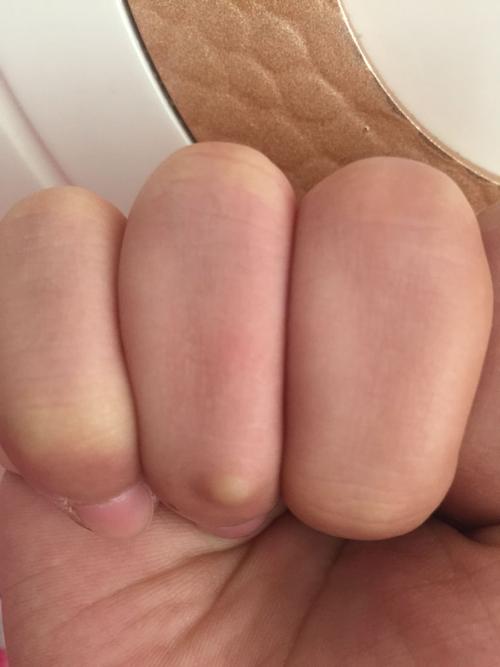 帮忙看看我这手指关节是长个骨刺吗?