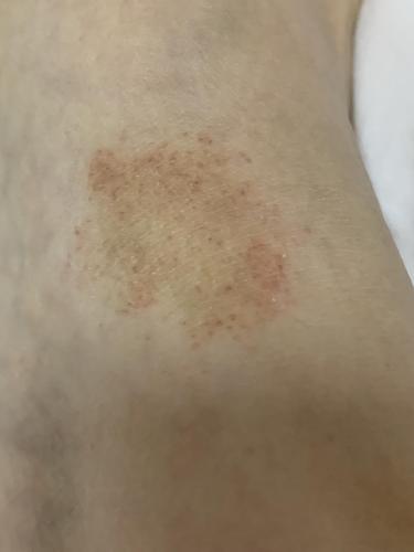 脚背及双腿局部长了几块红点,已经大半年.是紫癜吗