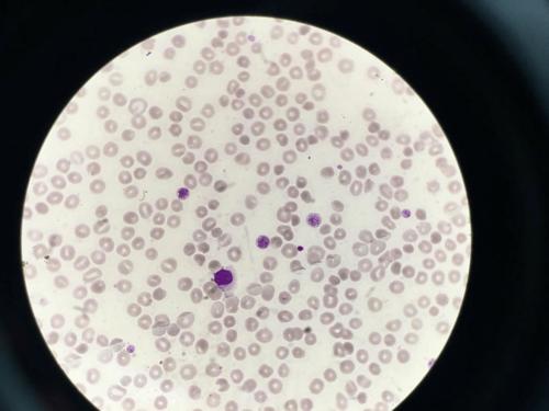 转油镜证实了一下,果然是大血小板.如图