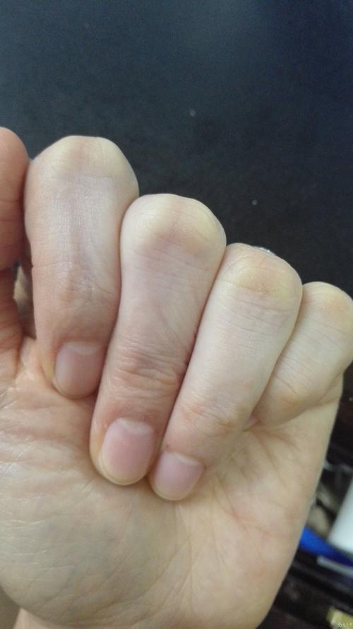 手指皮肤发白怎么回事