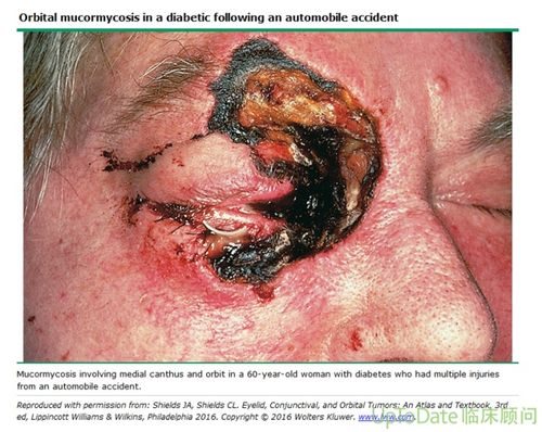 印度多个邦爆发新冠康复者感染毛霉菌病例,继"黑色霉菌"和"白色霉菌"