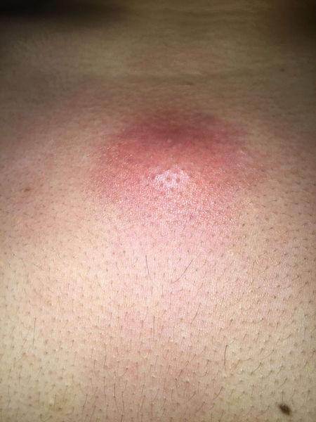 胸口长了一个类似痘痘的包