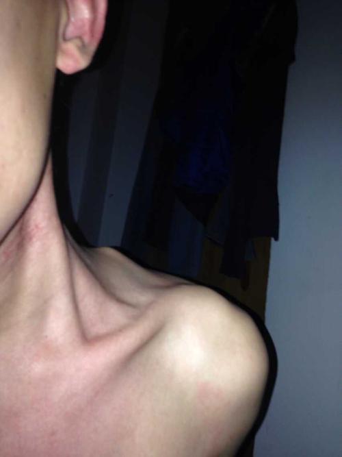 左边肩膀有个骨头突出