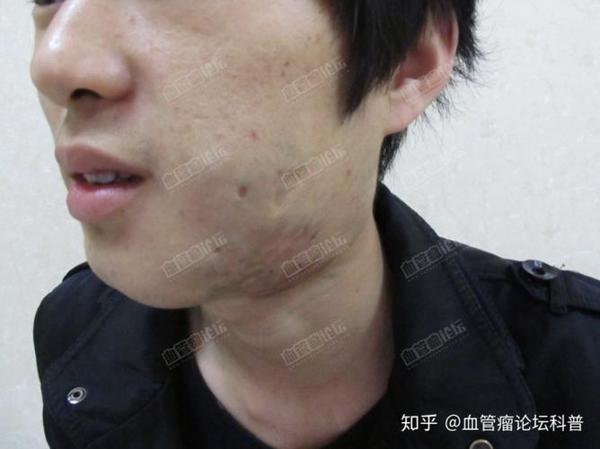 赵先生治疗中 生活现状 成年后步入社会,因脸上血管瘤备受歧视,找不