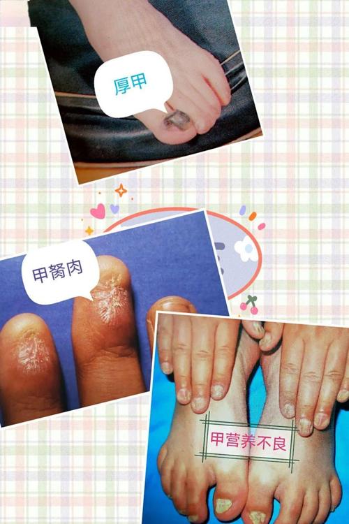 【老宋说事儿】正确认识指(趾)甲周病,指(趾)甲板病和指(趾)甲床病