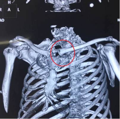 锁骨骨膜,做胸骨及锁骨骨膜下剥离,显露脱位处锁骨胸骨端及胸锁关节