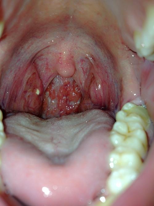 正常人的扁桃体图片