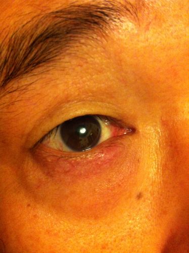 眼睛下面眼袋皮有红肿是怎么了,有点痛