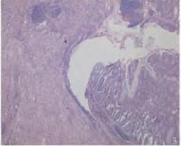 多发性浅表溃疡,肠壁全层高度水肿伴弥漫性淋巴细胞浸润及淋巴