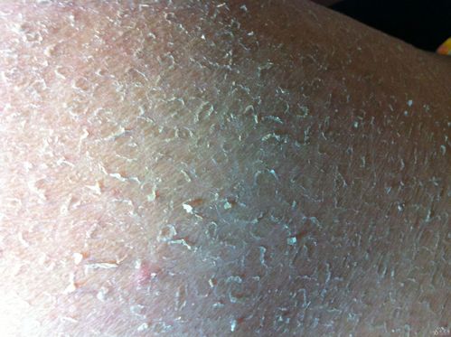 病例会诊一例红斑鳞屑性皮肤病鳞状毛囊角化症