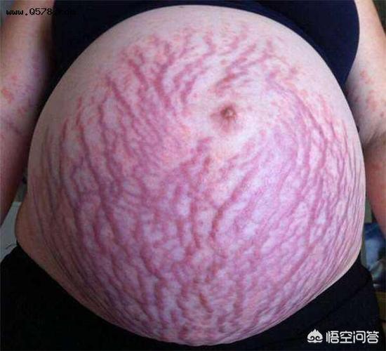 宝妈们是怀孕几个月时开始长妊娠纹的?