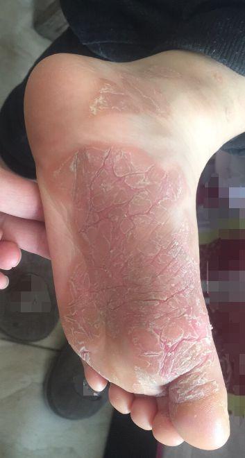 鳞屑角化型足癣让脚皮又厚又硬,还有裂纹,脱屑,瞬间让人感觉脚老了