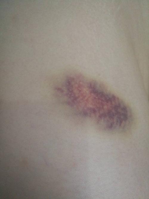 大腿外侧局部淤血,目测是毛细血管破裂,没有受到外力碰撞,不知道什么