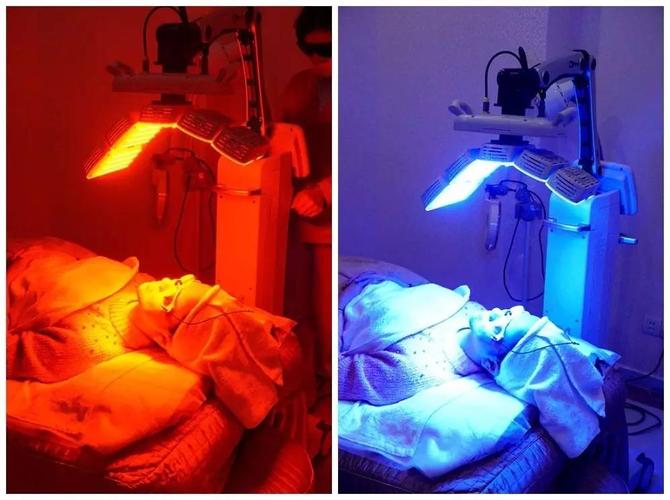 2.红蓝光——适用于轻中度痤疮