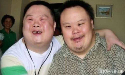 长大后的唐氏儿