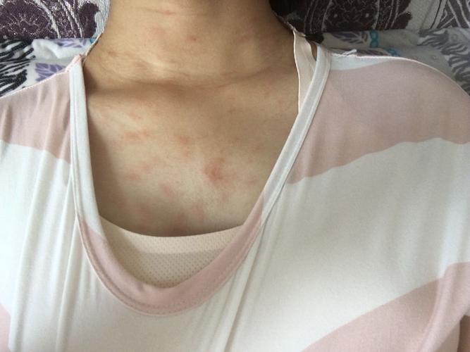 怀孕三个多月过敏了