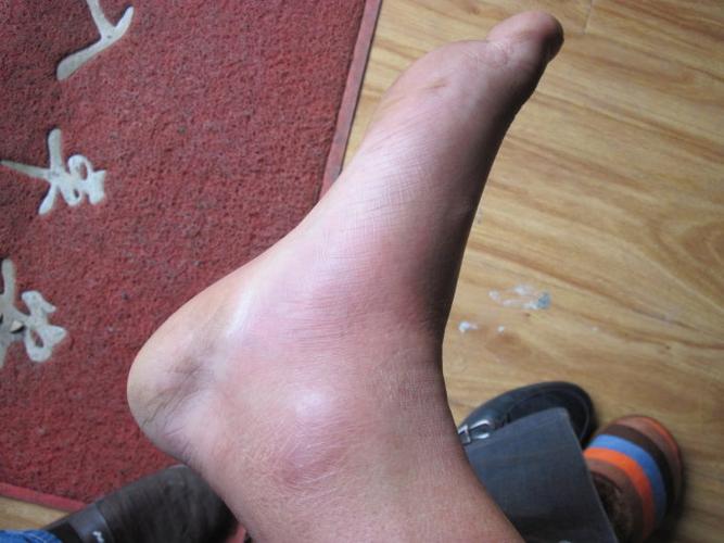 于2周前无明显诱因,感觉右踝关节处不适,后逐渐加重,疼痛明显,在当地