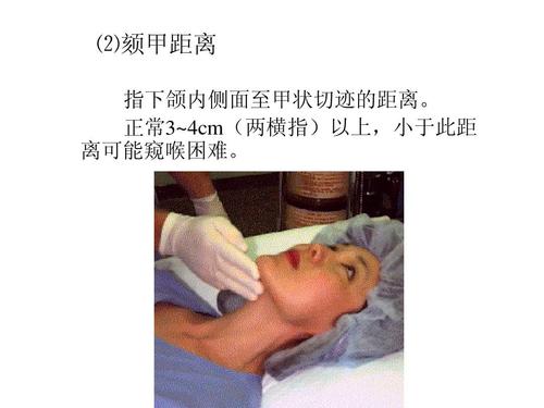 气管及支气管内插管-王艳青-湘雅 ⑵颏甲距离 指下颌内侧面至甲状切迹