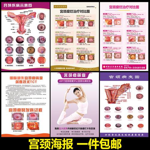 心怡广告的优惠券大全—宫颈疾病示意图妇科墙贴病变级别海报女性子宫