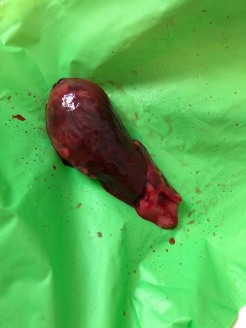 出血怀疑先兆流产腹痛一夜排出来的