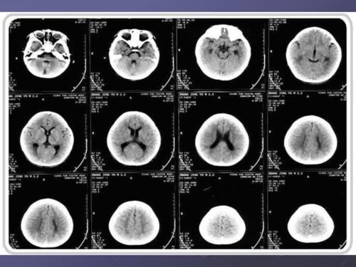 颅脑ct层面解剖