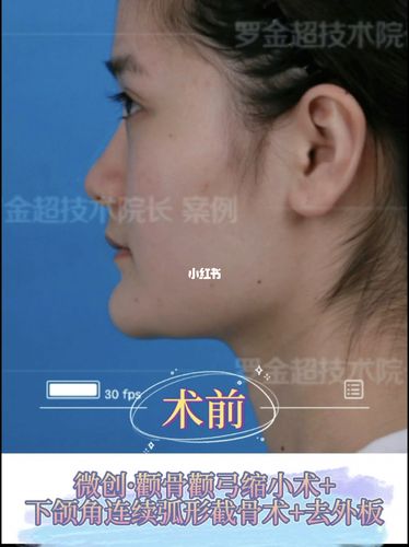 颧骨颧弓缩小 下颌角 去外板术后3个月_颧骨_下颌角_颧骨颧弓下颌角