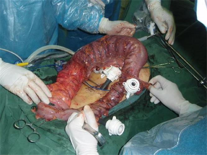 肠粘连开腹后图片 肠粘连解说高清图片 肠粘连的手术中图片