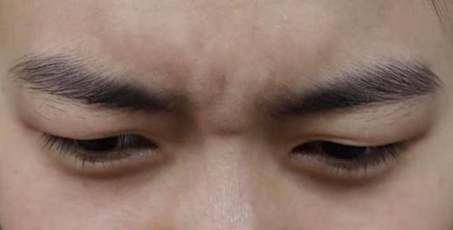 眉间纹