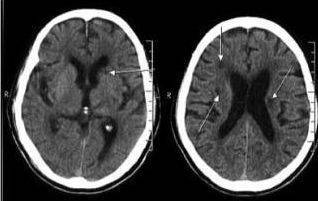 头ct提示既往得过脑梗死,但我没有症状,有事吗?