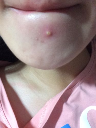 昨天发现下巴上长了白色痘痘 周围肿起来了而且很疼 于是用手挤出一些