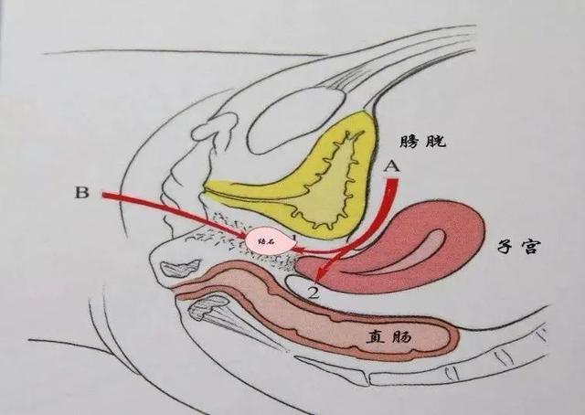 原创什么是石女先天无阴道是咋回事和正常女性有何区别