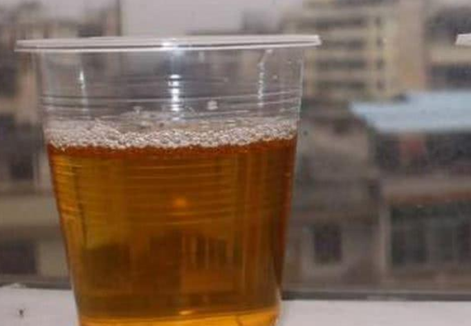 早上"第一泡尿",如若没有3个现象,恭喜你,肾脏很健康!