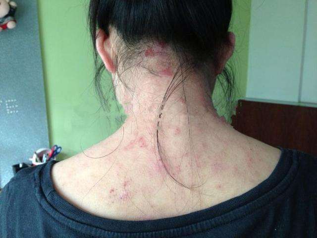 网易首页>网易号>正文申请入驻> 第一种淋巴结肿大,当人们感染艾滋病