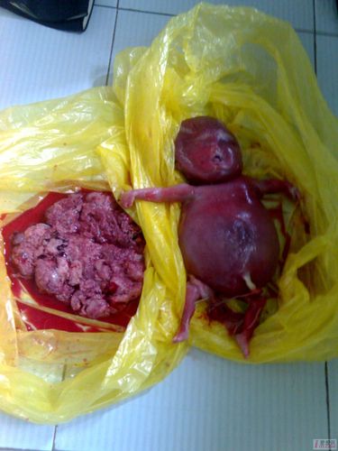 [妇科] barts胎儿水肿综合征图片