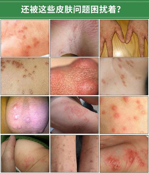 超级新品 【买2送1】冰磺肤乐抑菌疥疮膏20g 疥虫疥螨一扫光疥舒灵霜