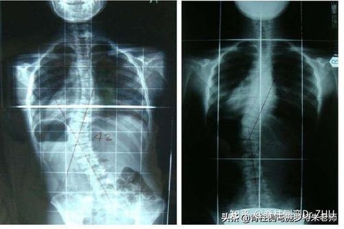 前几天有人咨询我,说自己之前确诊了脊柱侧弯,度数已经超过了40度