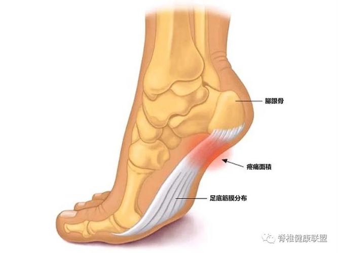 2.足跟脂肪垫炎