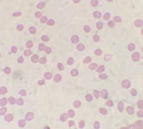 教科书都没这样写血小板假性升高竟是