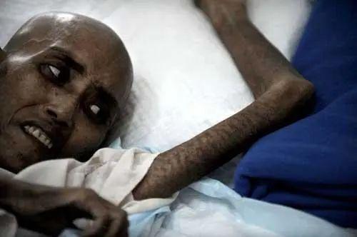 艾滋病人是不是都很瘦