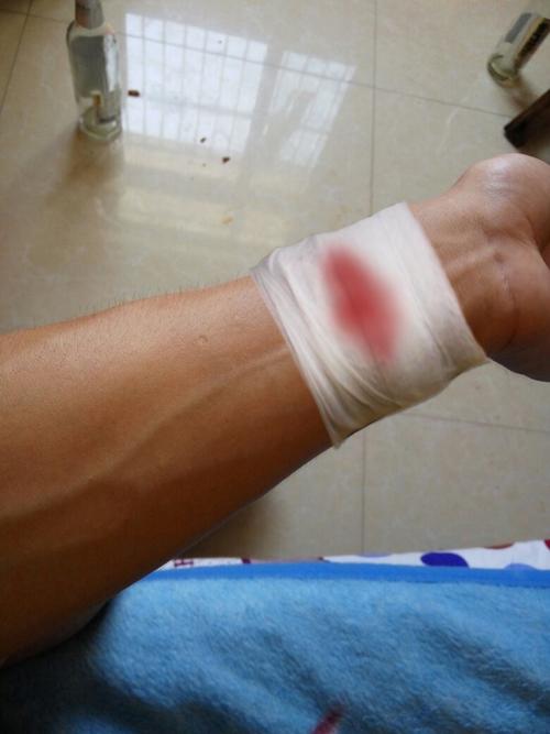 求大神帮p一张手腕受伤包扎的图片.包扎图到手腕那里就行.