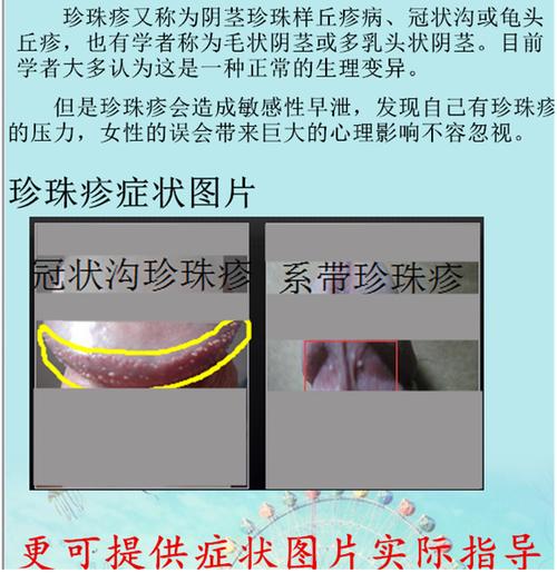 延时增大教程(发送邮箱给客服索取) 珍珠疹表面症状为:冠状沟突出一排