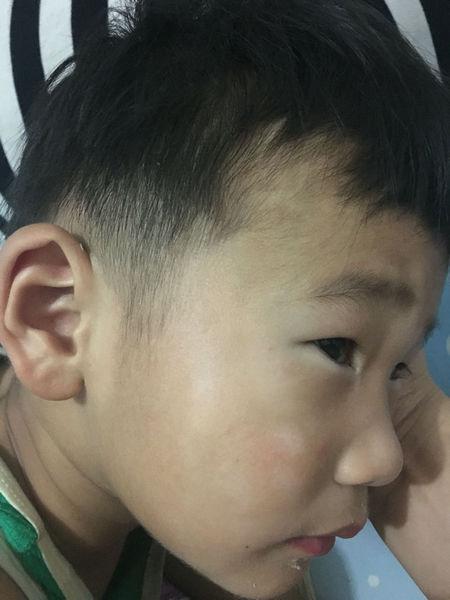 孩子脸上一块白,一块白的,是怎么回事?是癣还是体内缺