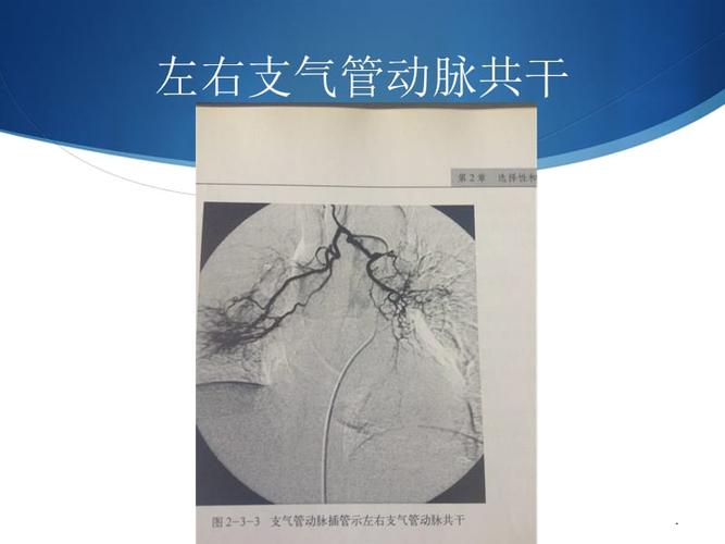 支气管动脉的解剖及病变ppt课件